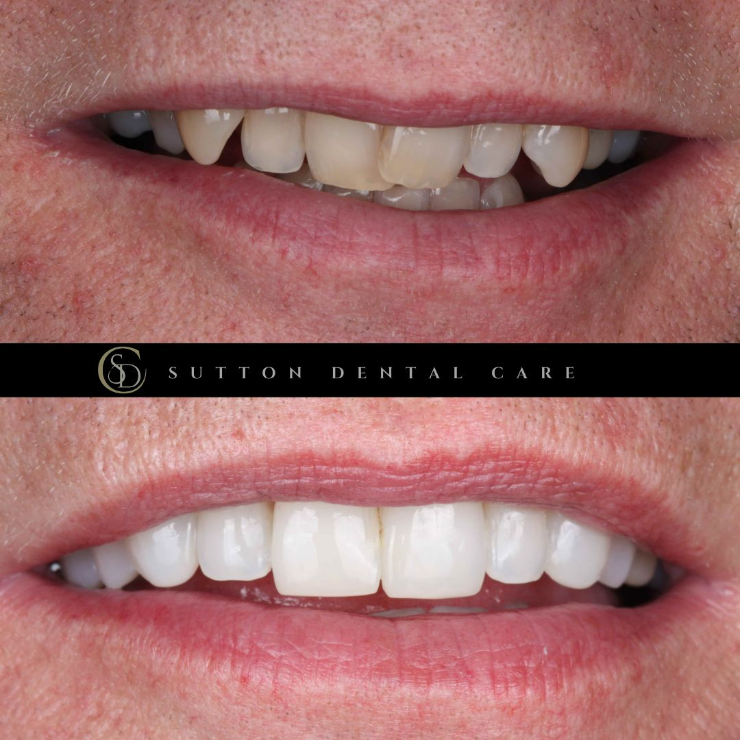 Aligners & Composite Bonding - Before & After