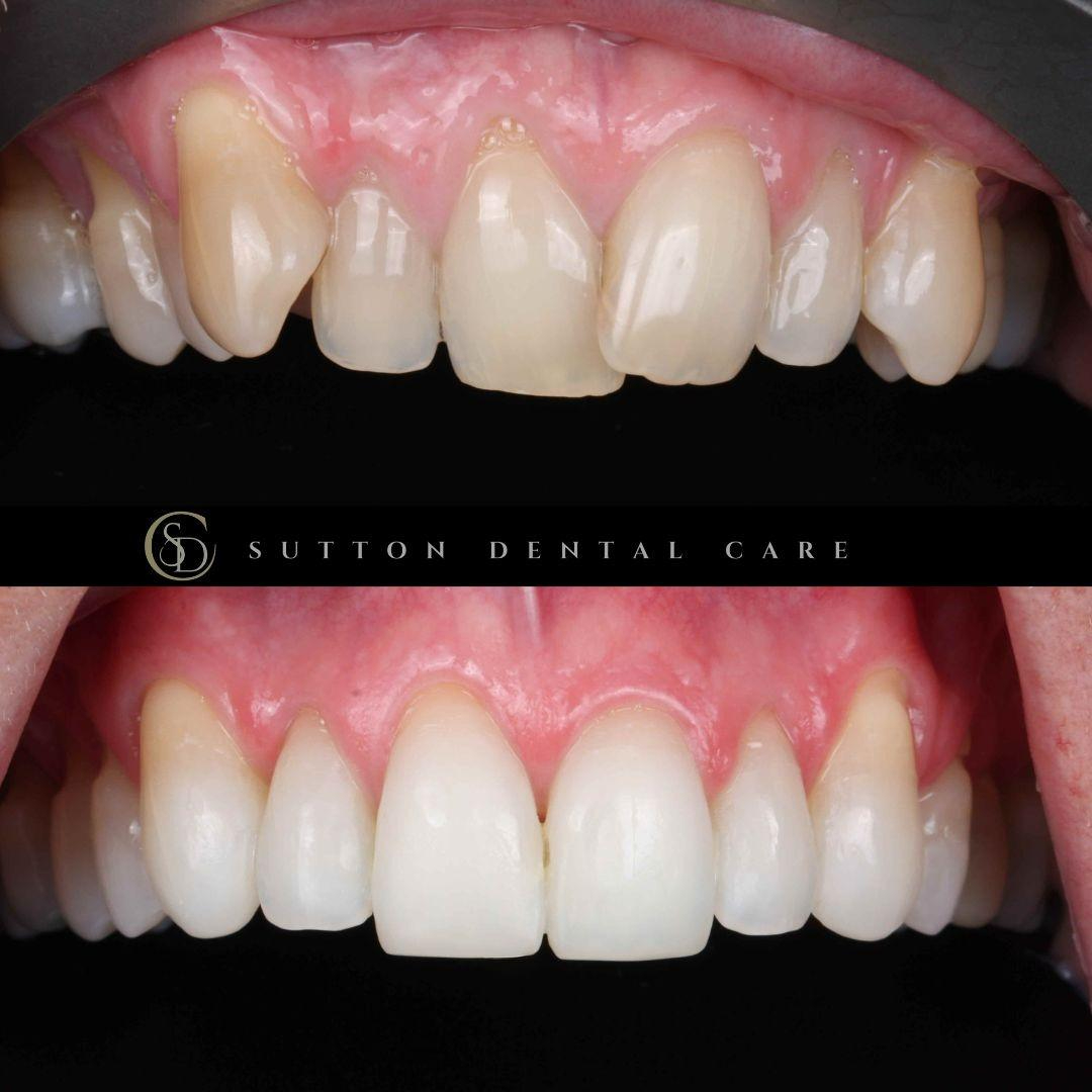Aligners & Composite Bonding - Before & After