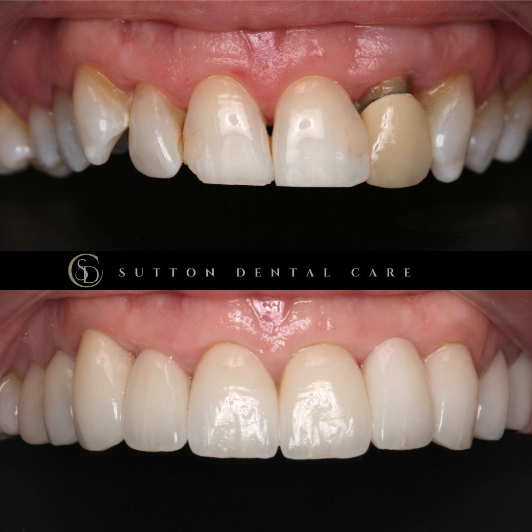 Bridge & Smile Makeover - Before & After