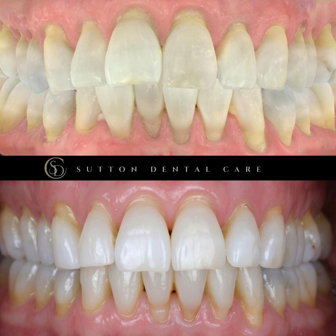 Clear Aligners - Before & After
