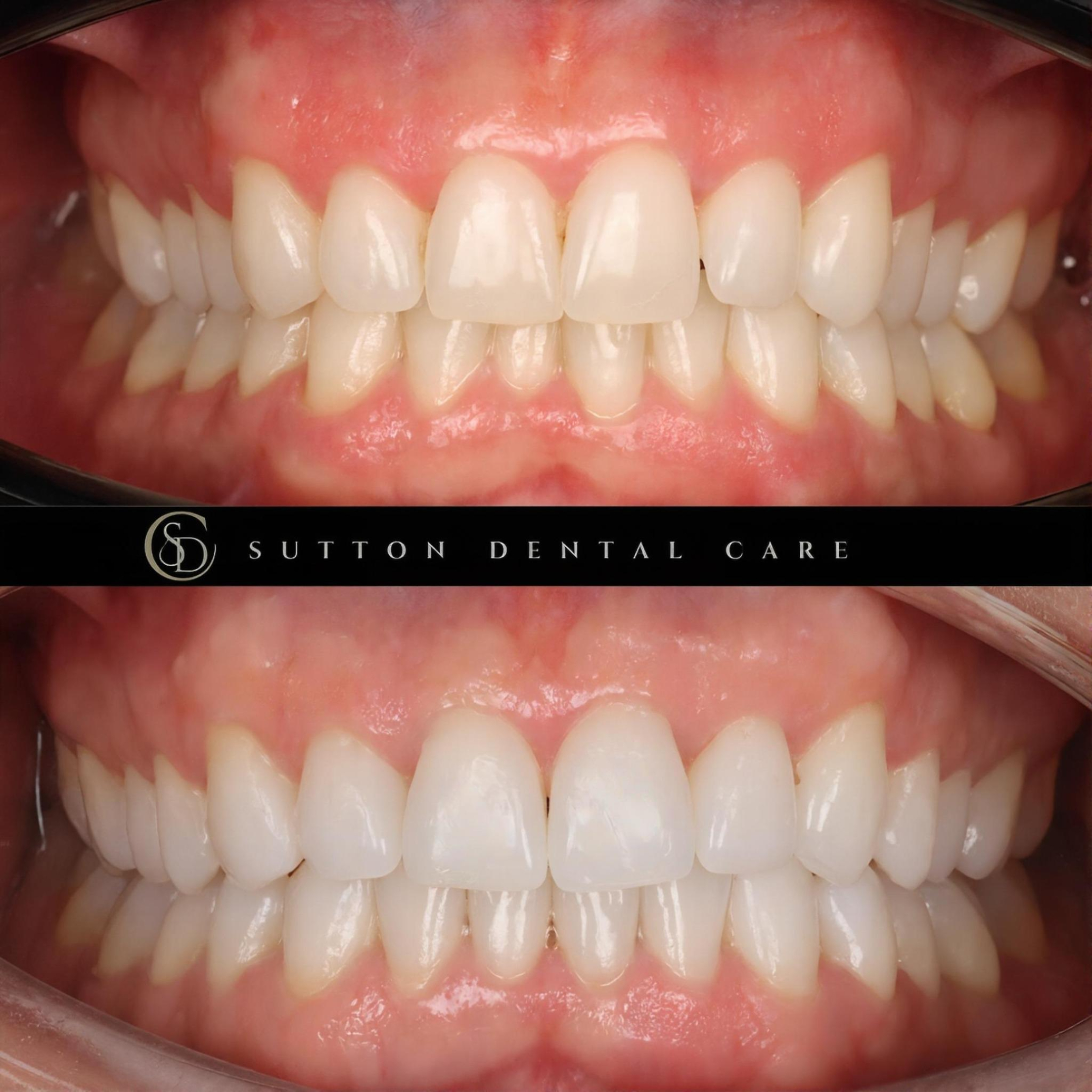 Clear Aligners - Before & After