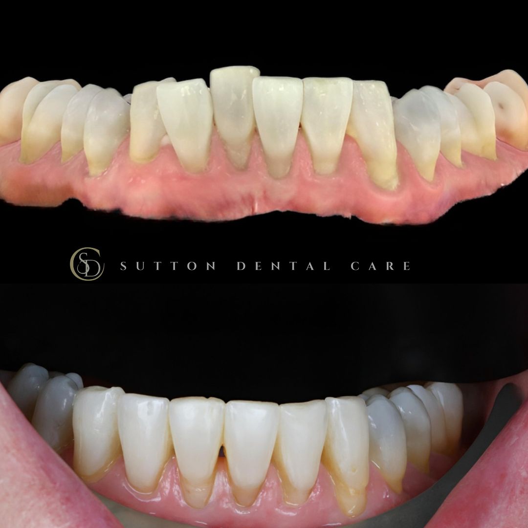 Clear Aligners - Before & After