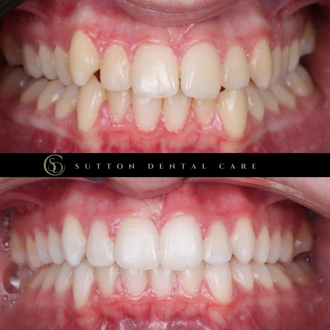 Clear Aligners - Before & After