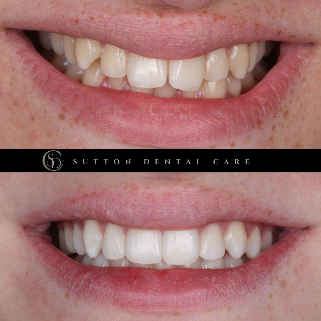 Clear Aligners - Before & After