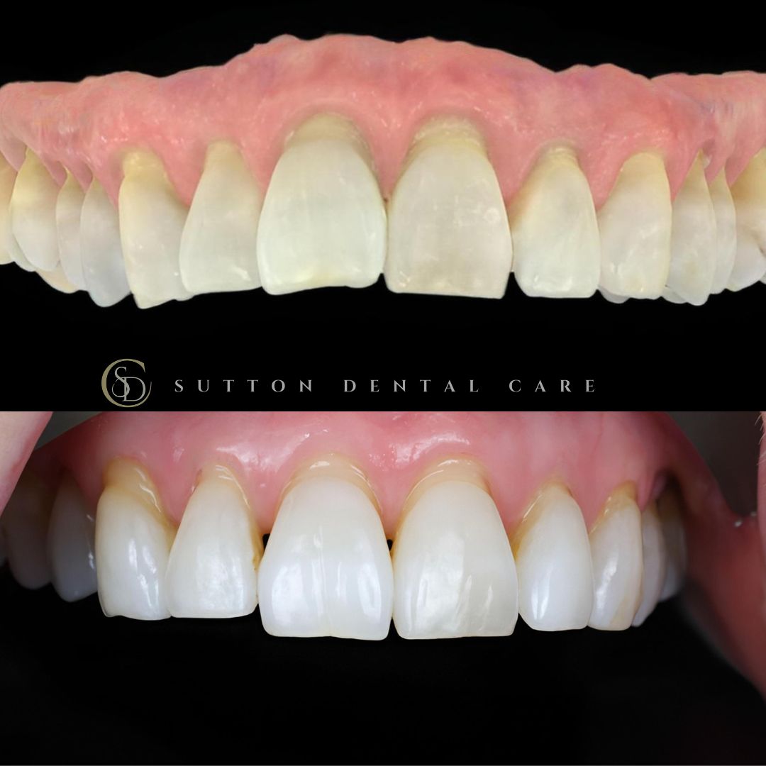 Clear Aligners - Before & After