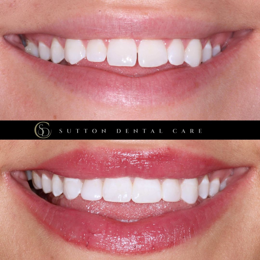 Composite Bonding - Before & After