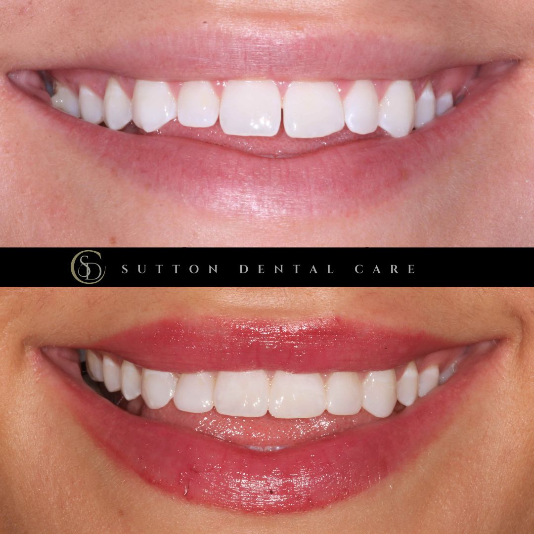 Composite Bonding - Before & After