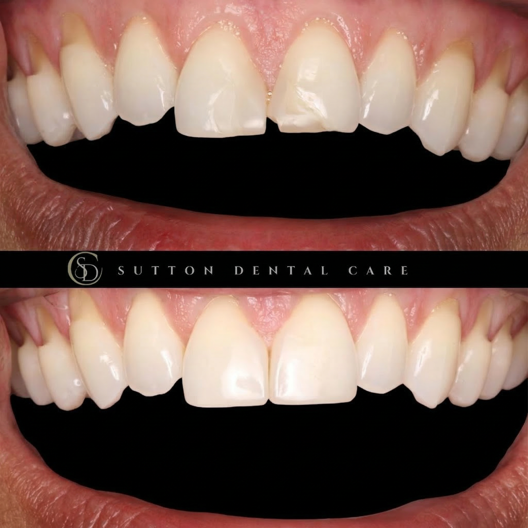 Composite Bonding - Before & After