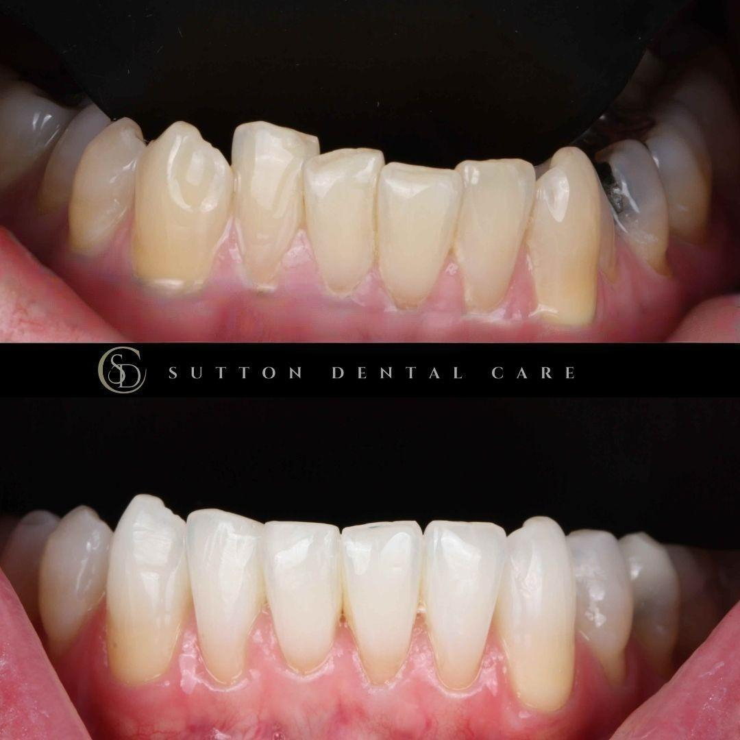 Clear Aligners & Composite Bonding - Before & After