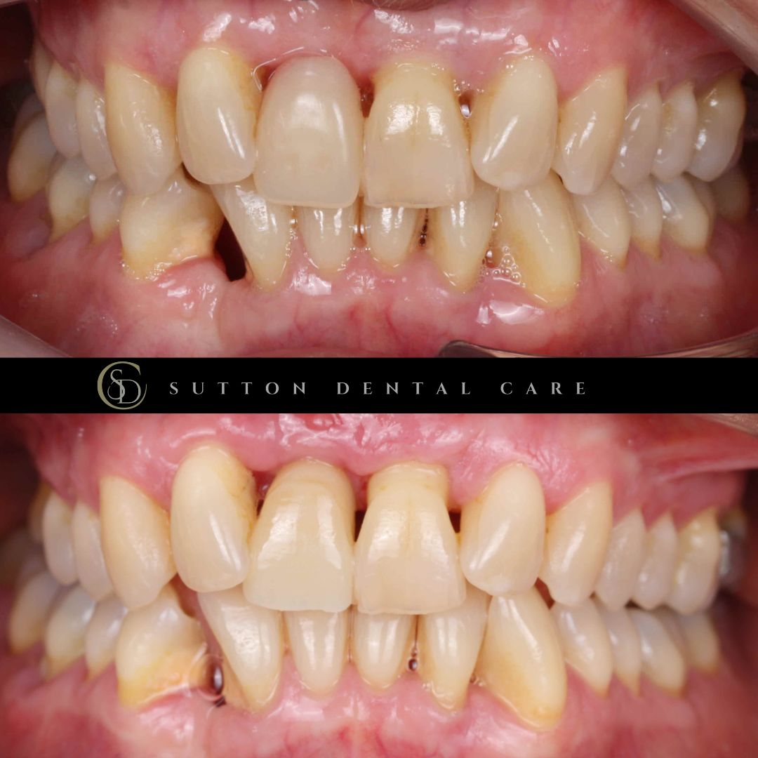 Dental Implant - Before & After