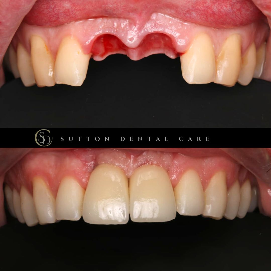 Dental Implant - Before & After