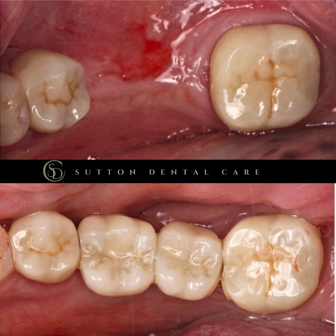 Dental Implants - Before & After
