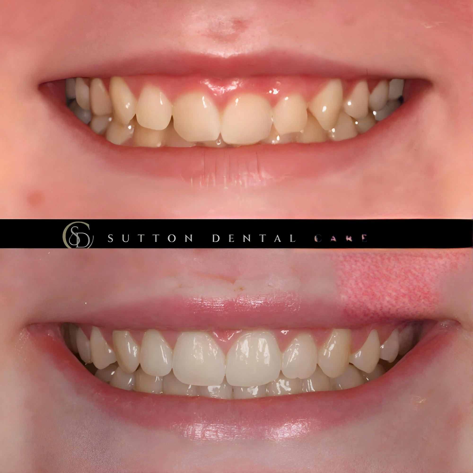 Fixed Braces - Before & After