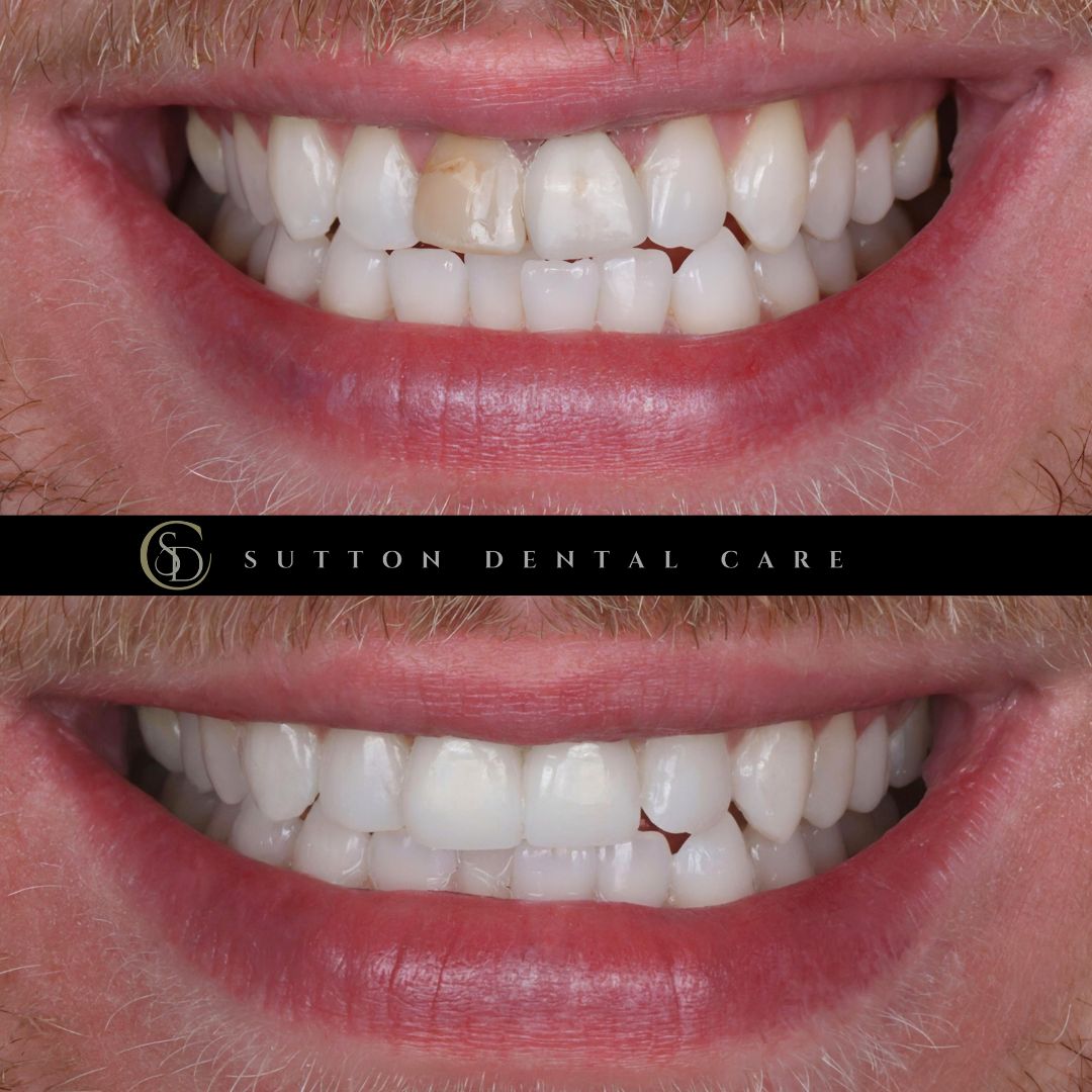 Root Canal, Whitening & Crowns - Before & After