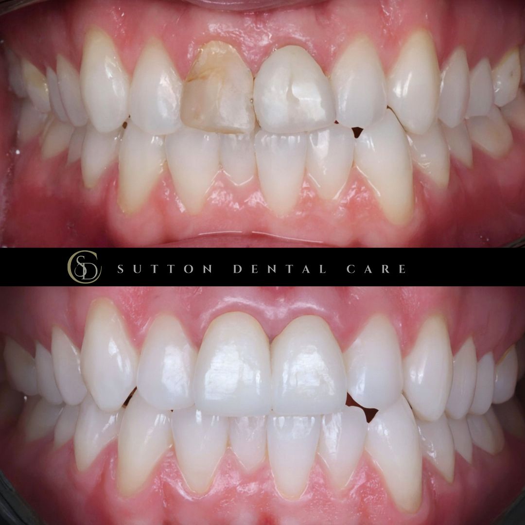 Root Canal, Whitening & Crowns - Before & After