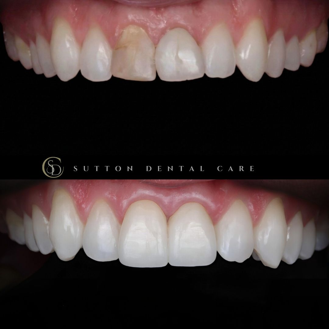 Root Canal, Whitening & Crowns - Before & After