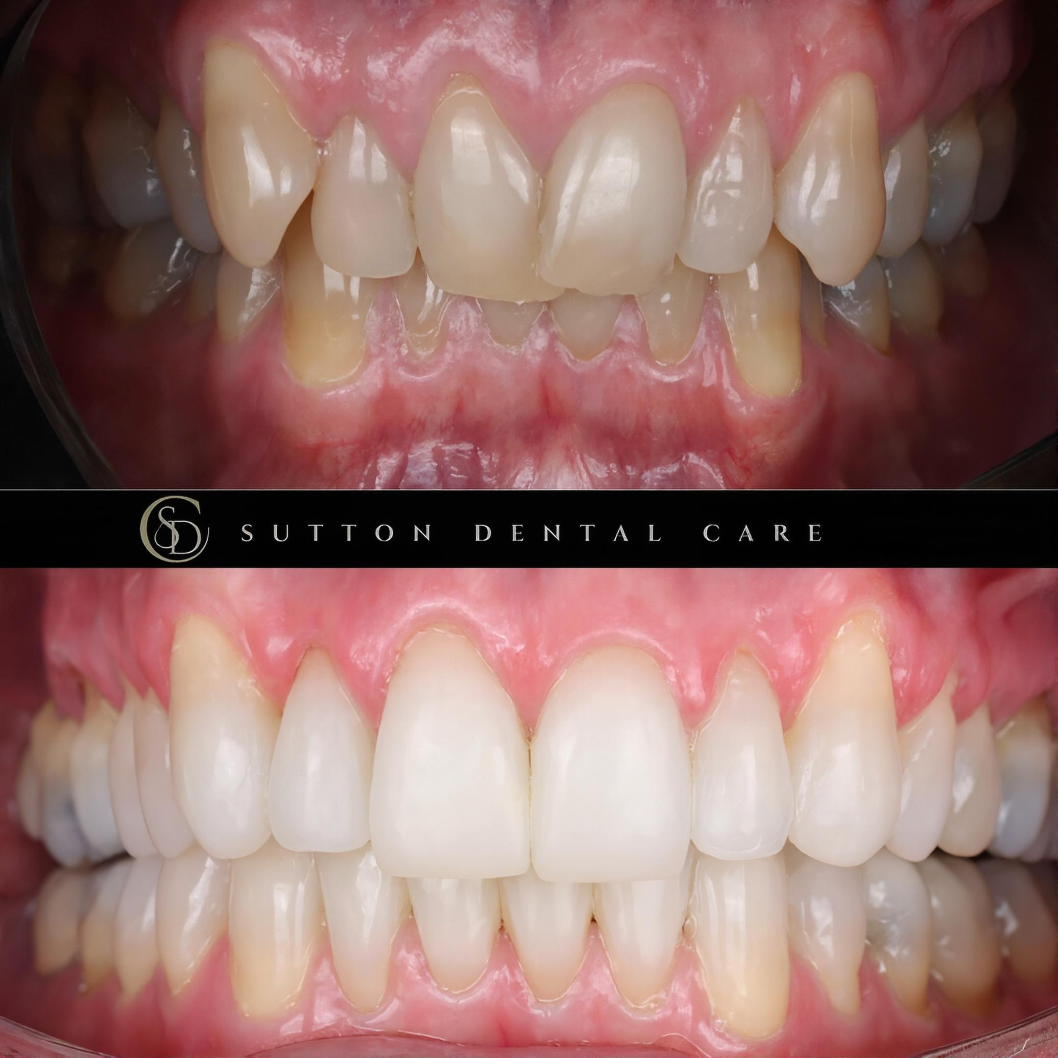 Smile Makeover - Before & After