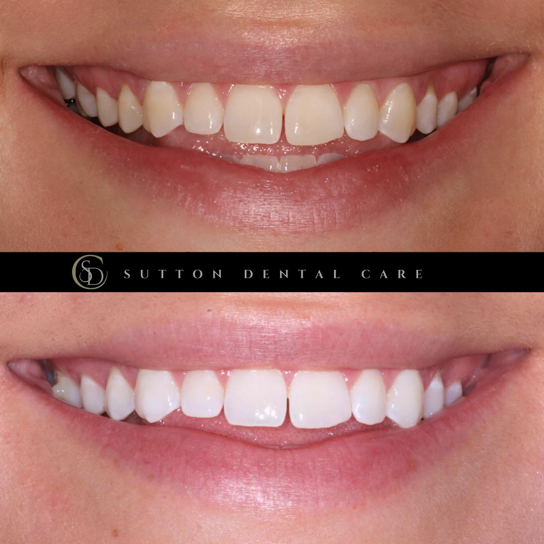 Teeth Whitening - Before & After