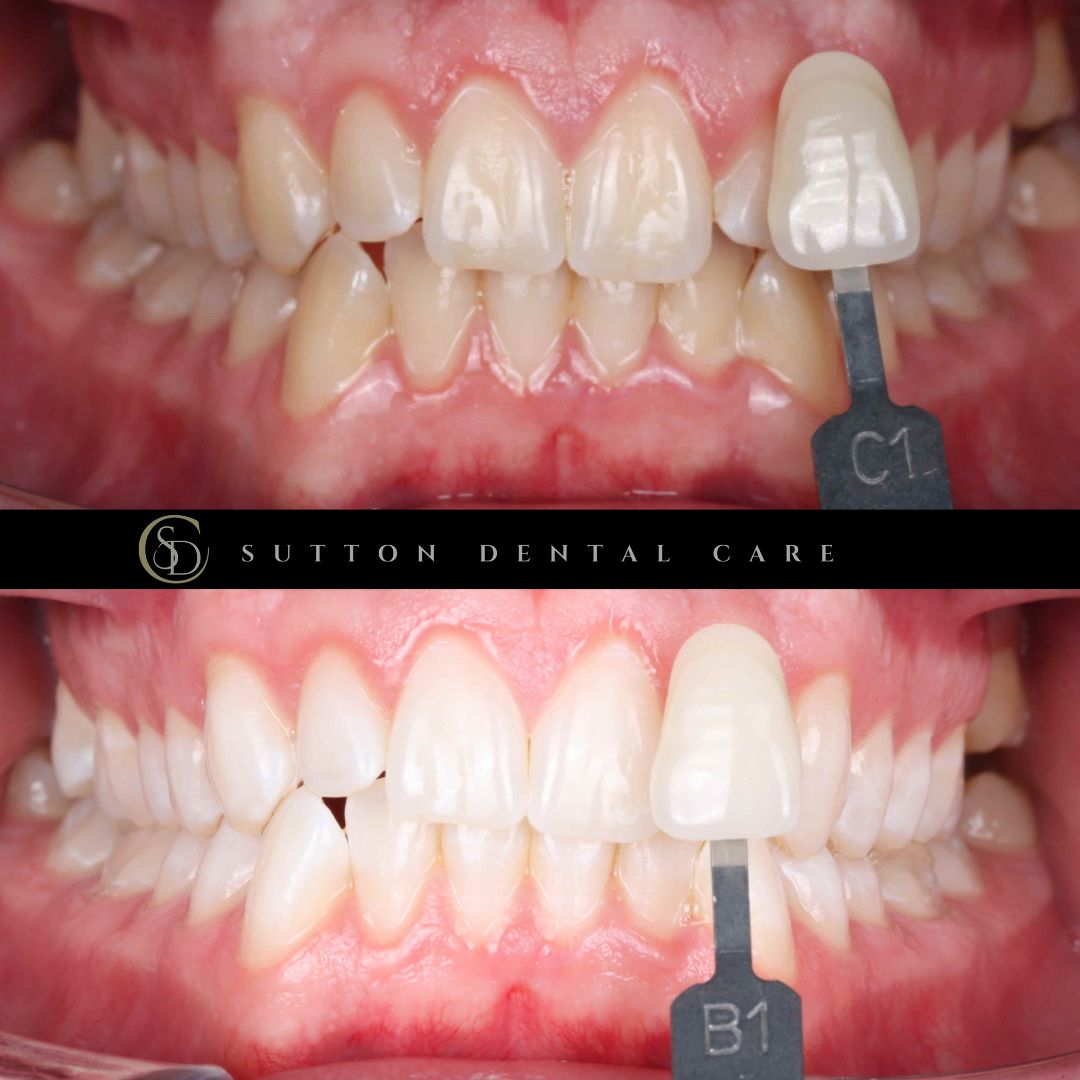 Teeth Whitening - Before & After