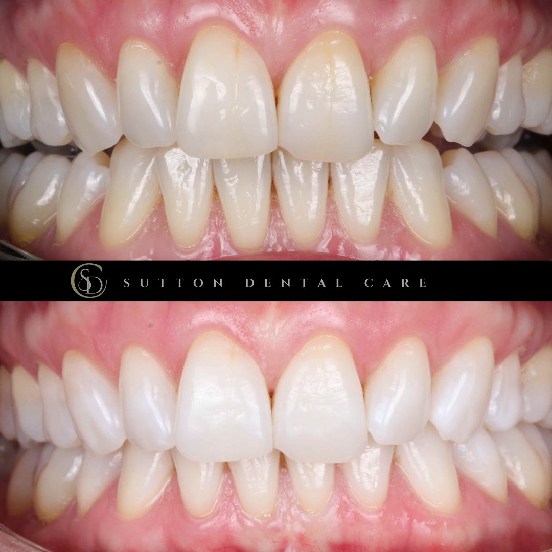 Teeth Whitening - Before & After