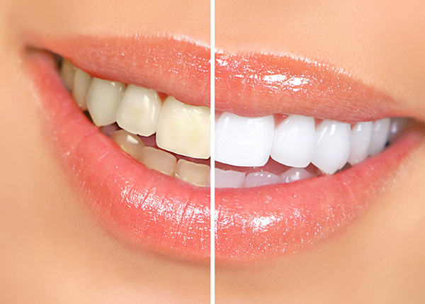 Teeth whitening before and after results in Sutton Coldfield