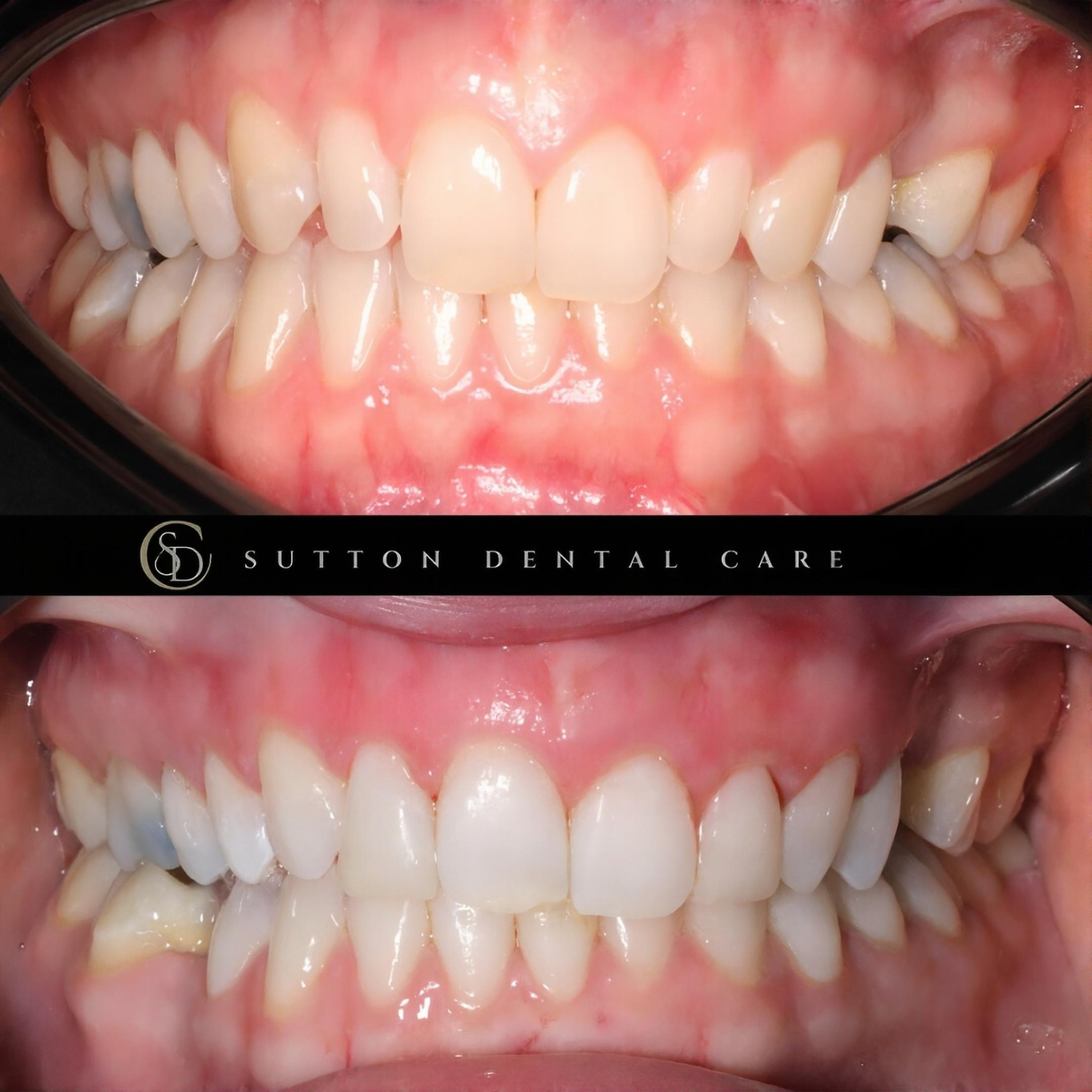 Whitening, Bonding & Bridge - Before & After