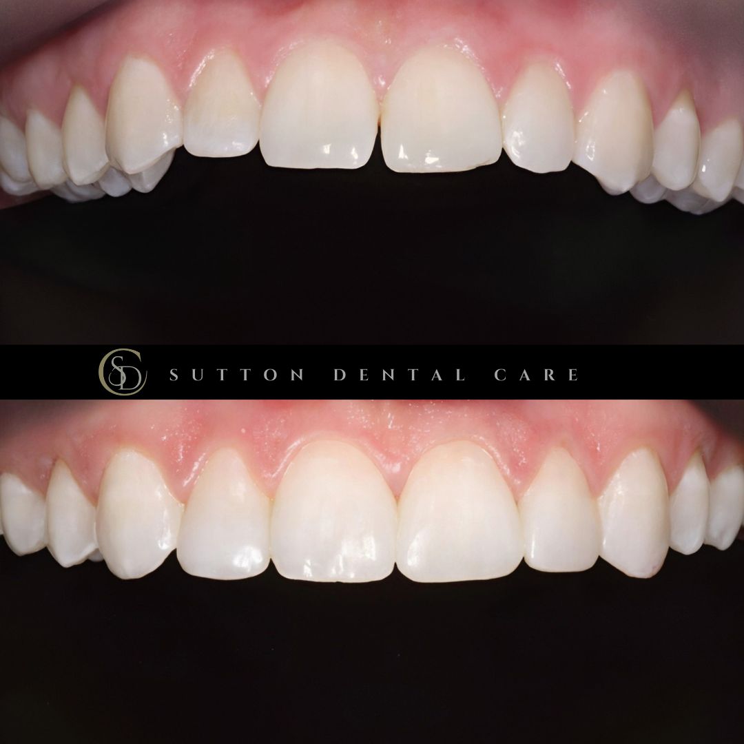 Whitening & Composite Bonding - Before & After