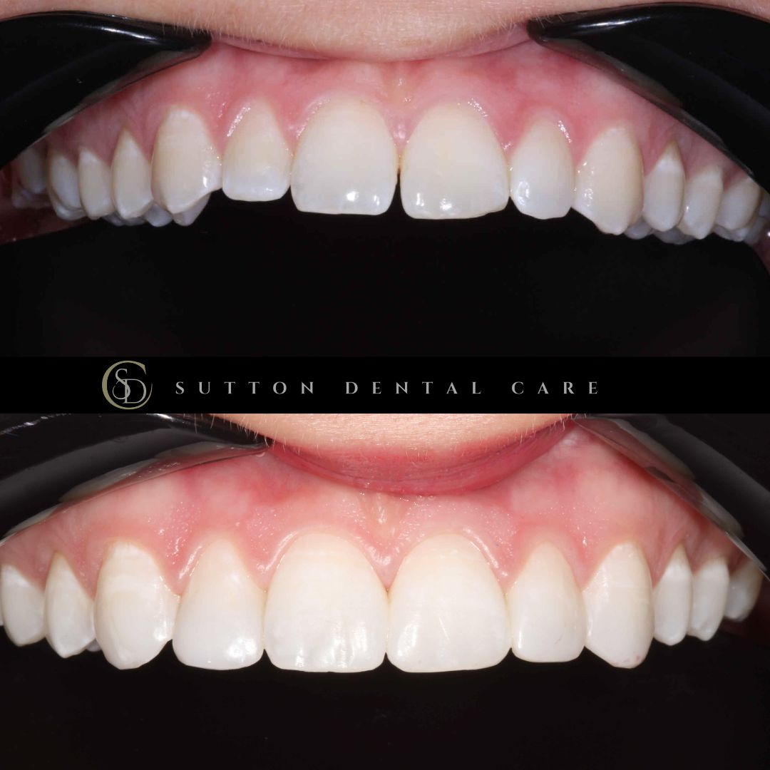 Whitening & Composite Bonding - Before & After