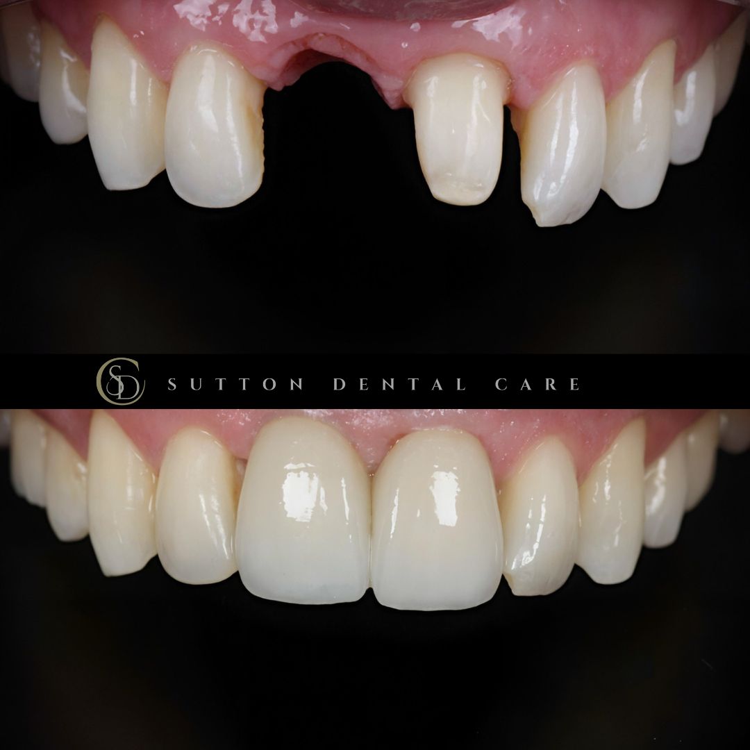Whitening, Crown & Implant - Before & After