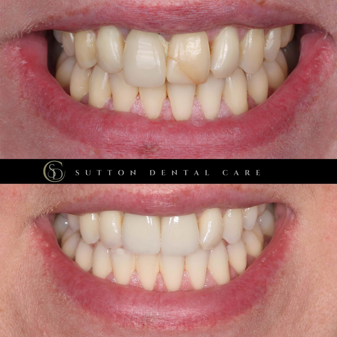 Whitening, Crown & Implant - Before & After