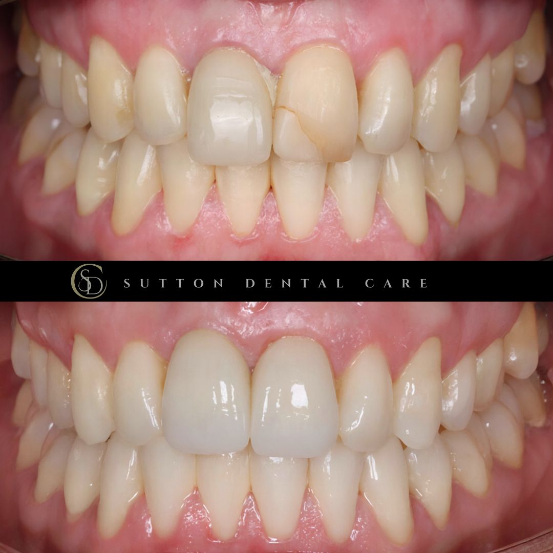Whitening, Crown & Implant - Before & After