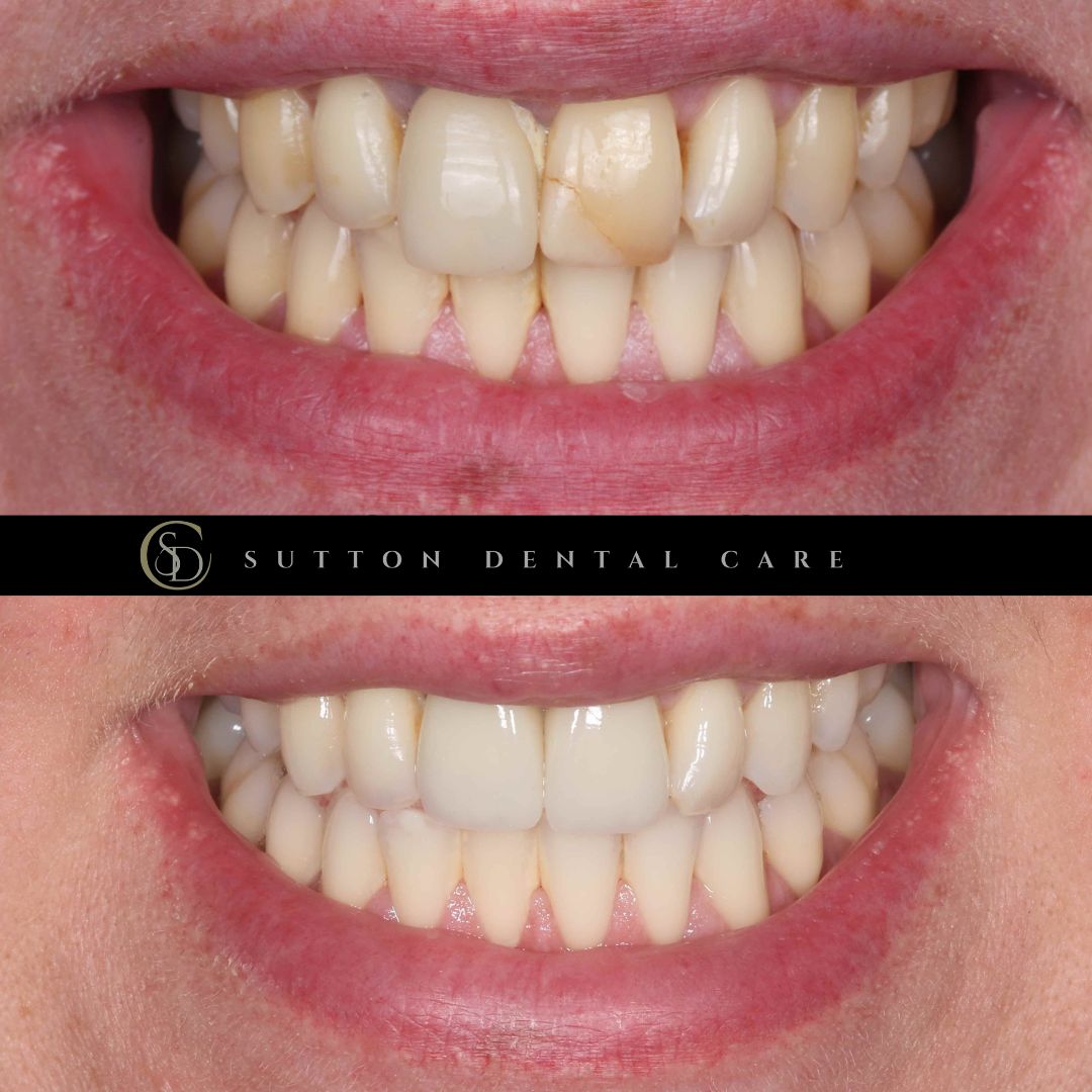 Whitening, Crown & Implant - Before & After